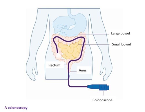colonoscopy graphic